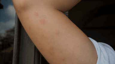 Cover Image for Chinches de cama: cómo reconocerlas, por qué aumentan en esta época y qué hacer antes de que se te instalen